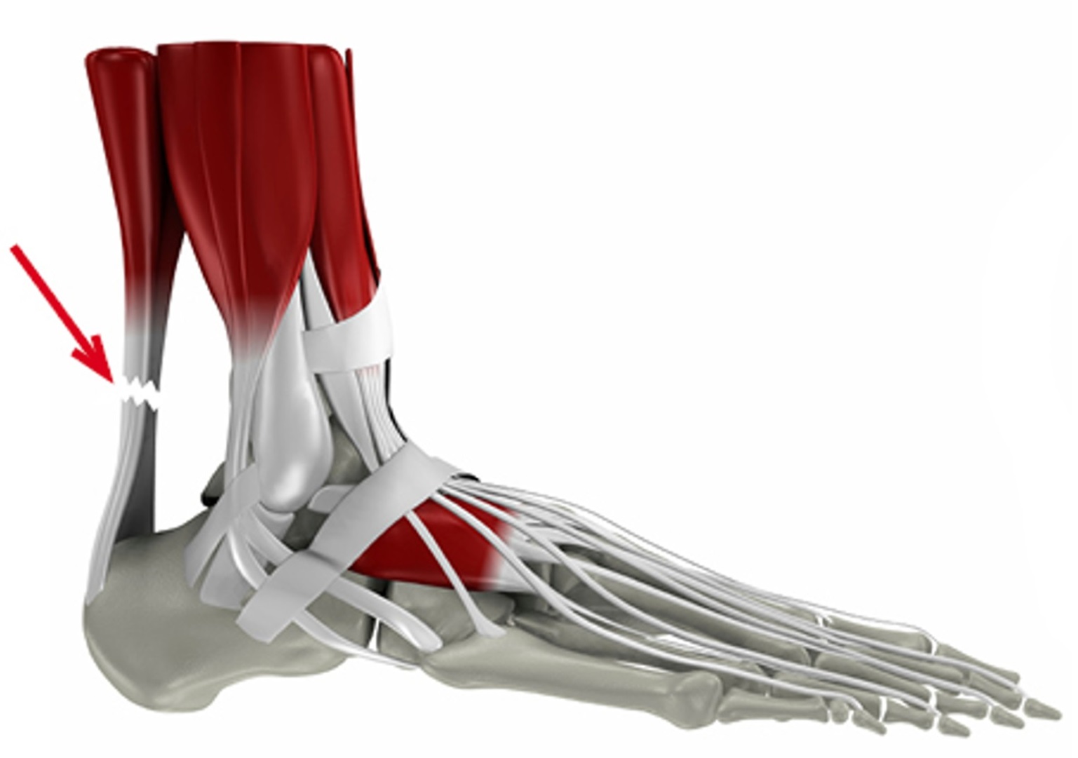 Achillessehnenverletzungen